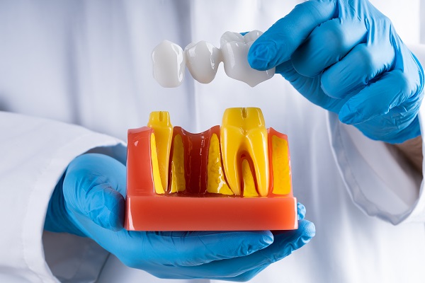 When Would A Dentist Recommend Dental Bridges?