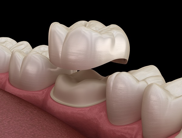 When Are Dental Crowns Recommended By Dentists?