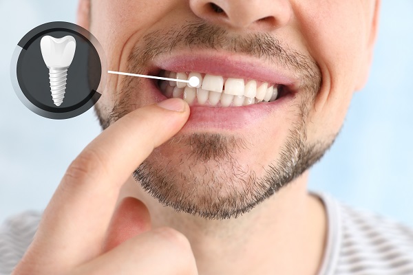 Consider Dental Implants For Replacing A Missing Tooth