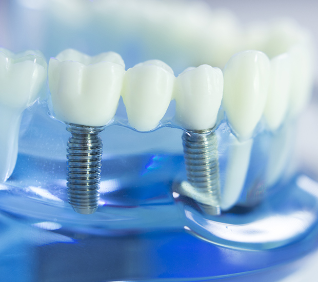 Suffern The Dental Implant Procedure